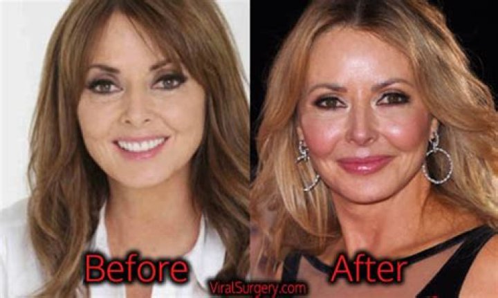 Carol Plastic Surgery Facelift, Botox Before and After Photos